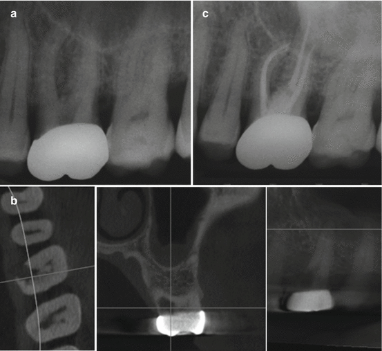 Introduction Endodontic Prognosis and SpringerLink
