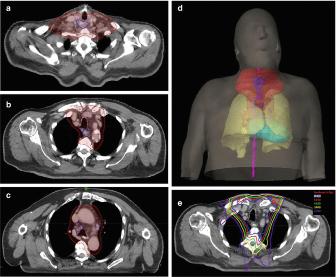 Esophageal Cancer Radiation Therapy Planning SpringerLink
