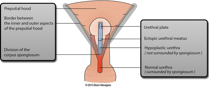 Hypospadias Variants | SpringerLink