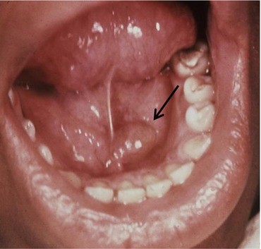 Mucosal Lumps And Bumps With Smooth Surfaces Springerlink