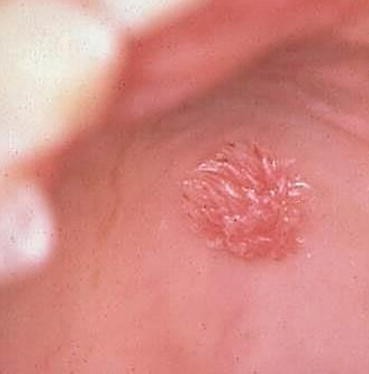 Tratamentul carcinoamelor de planşeu oral anterior, Squamous papilloma of mouth