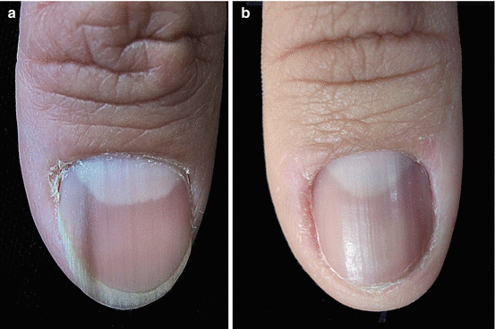 Pigmented Onychomycosis (Fungal Melanonychia) | SpringerLink