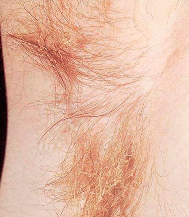 Fungal Skin Infections Mycology Springerlink Fungal Skin Infections Mycology Springerlink