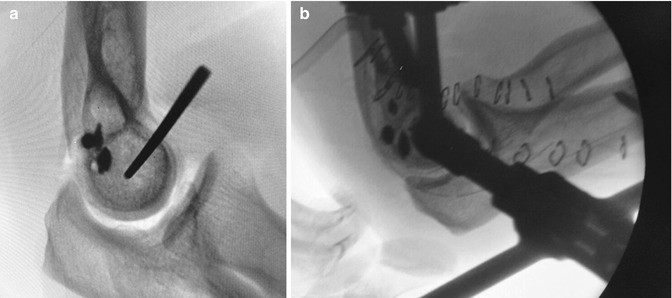 External Fixation For Upper Extremity Trauma Springerlink
