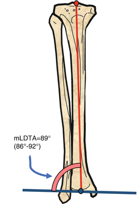 Frontal Plane Deformities And Drawing Axes Of The Long Bones Springerlink