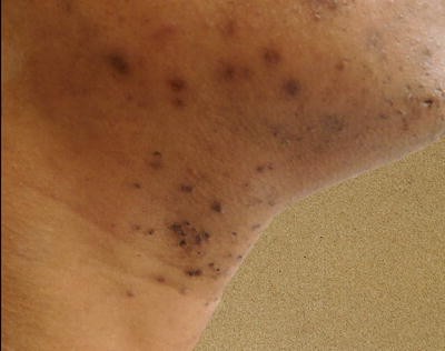 Pseudofolliculitis Barbae And Acne Keloidalis Nuchae Springerlink