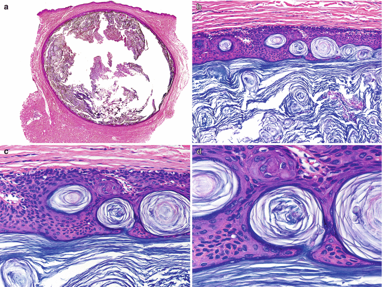 Infundibular Cyst Springerlink