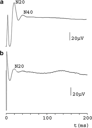 Evozierte Potentiale Ms