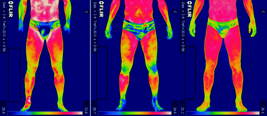 Infrared Thermography For The Detection Of Injury In Sports Medicine Springerlink