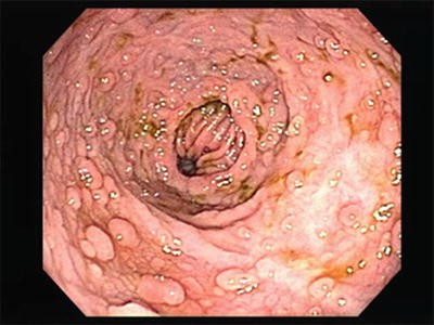 Colonoscopy Photo Atlas Springerlink - 