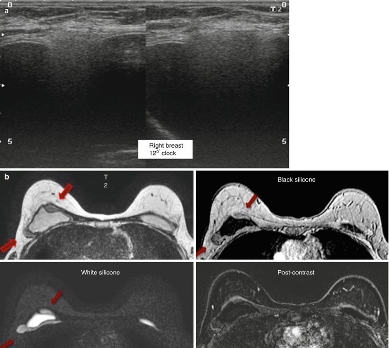 Imaging Findings After Surgery SpringerLink