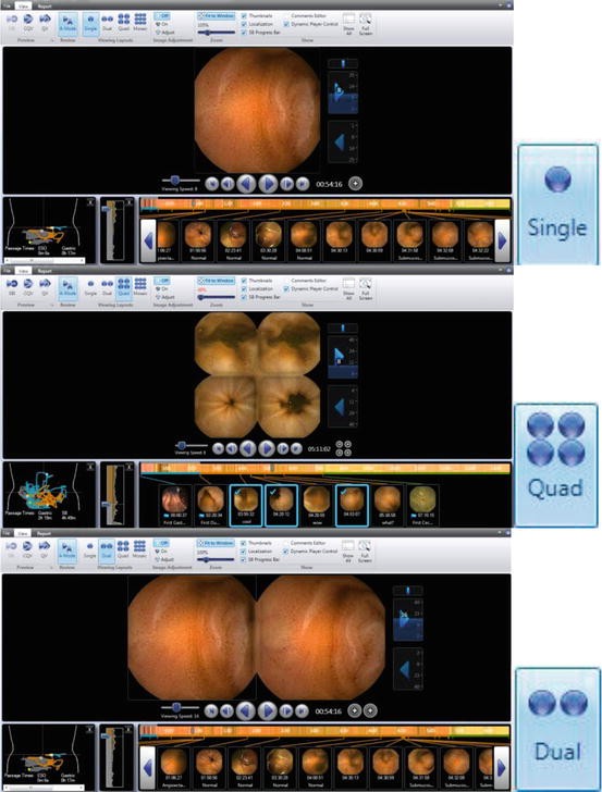 How to Read a Small Bowel Capsule Endoscopy Study SpringerLink