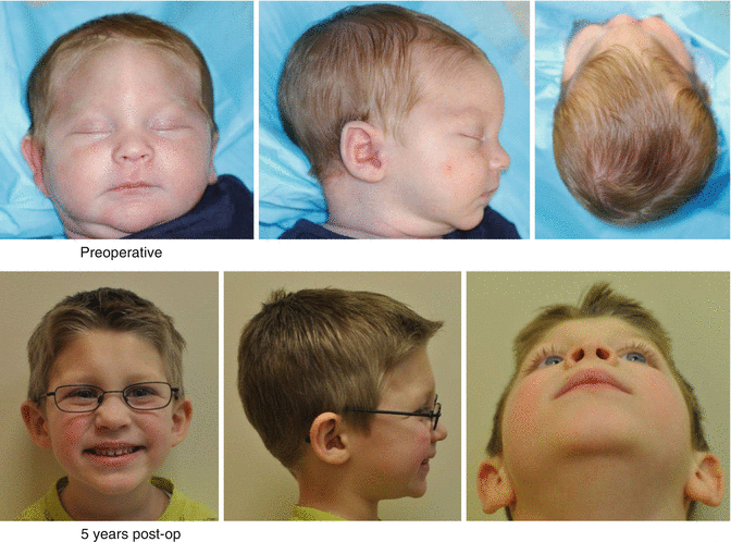 plagiocephaly 3 year old