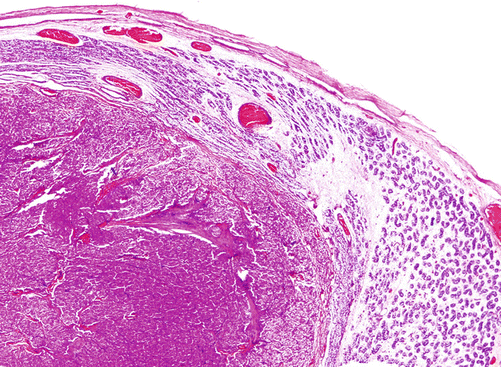 hirsutoid papillomas histology)