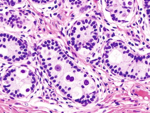 androgen insensivity chromatin negative nuclei androgen insensivity chromatin negative nuclei