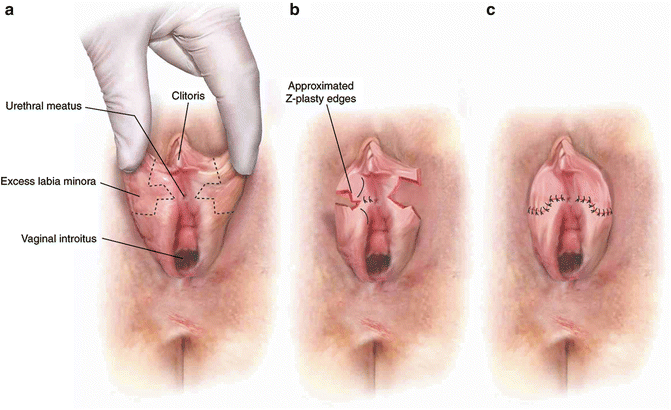 Cosmetic Gynecologic Surgery Springerlink