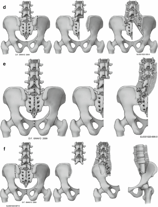 Sacral Biomechanics and Reconstruction | SpringerLink