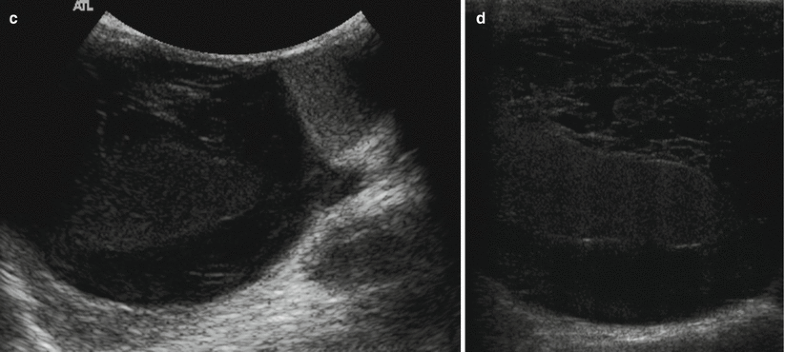 Extratesticular Lesions | SpringerLink