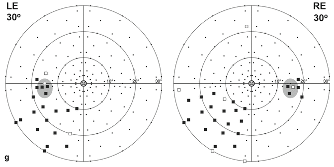 Types of Homonymous Visual Field Defects | SpringerLink