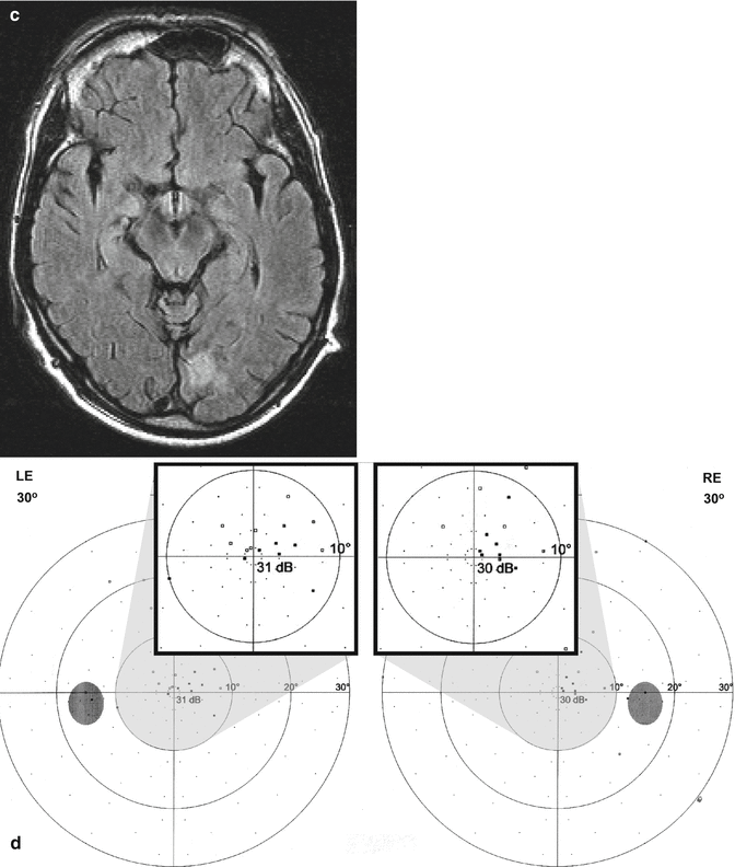 Types of Homonymous Visual Field Defects | SpringerLink