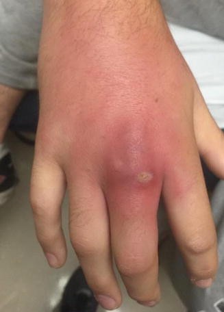 dog bite cellulitis treatment