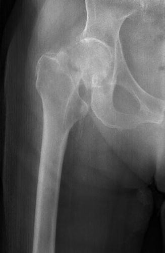 Hip Fractures Springerlink