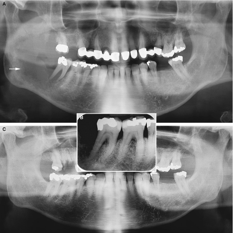 Malignant Tumors in Jaws SpringerLink