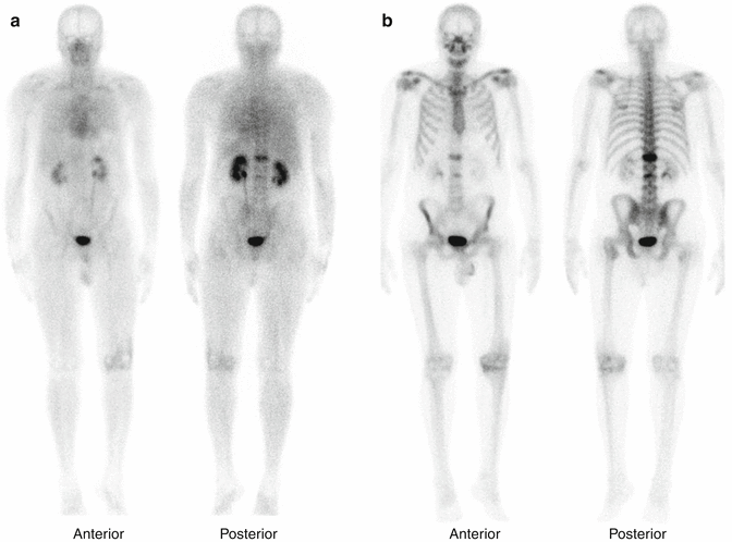 prostatitis vagy osteochondrosis