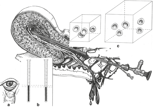 Complications During Hysteroscopy Springerlink