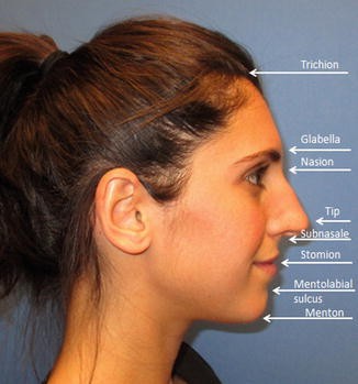 mentolabial sulcus filler