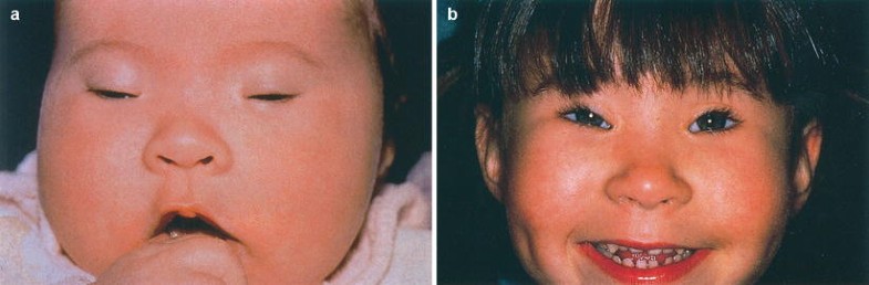 Developmental Eyelid Abnormalities Springerlink