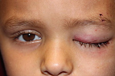 Pediatric Eyelid And Adnexal Trauma Springerlink