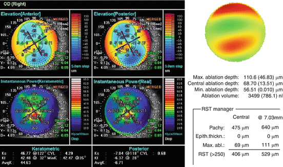 Refractive Crosslinking Acxl Plus Springerlink