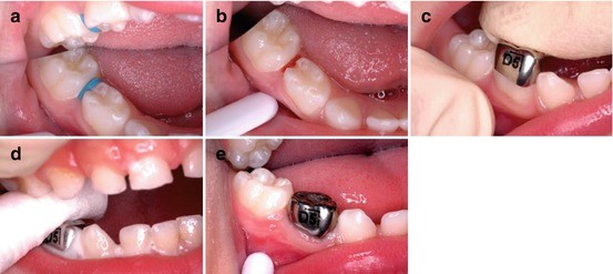 Management Of Deep Carious Lesions Through Sealing In - 