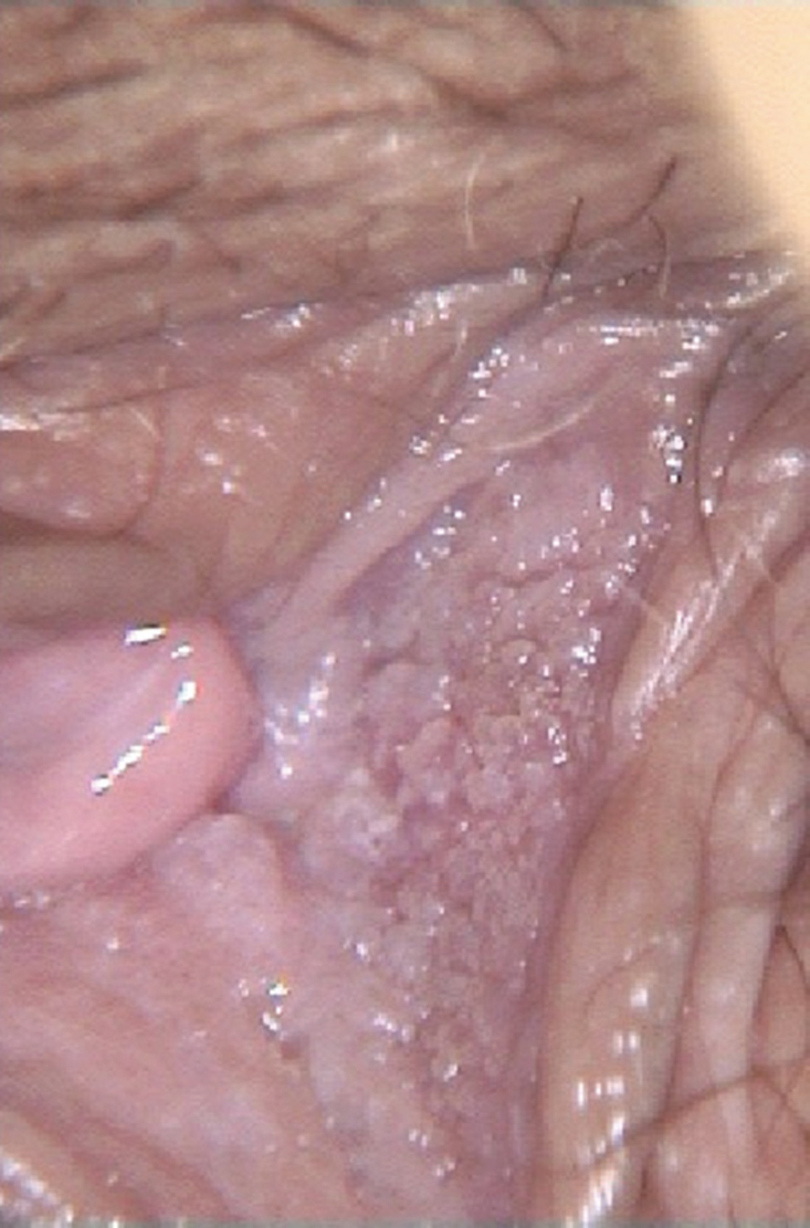 Vestibularis papillae vs hpv