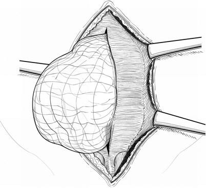 Open Repair Springerlink