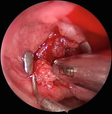 laryngeal papillomatosis pneumothorax