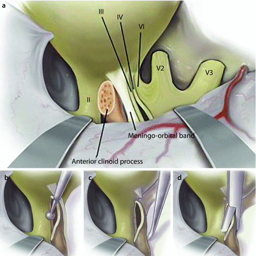 Vascular Lesions Of The Skull Base Springerlink