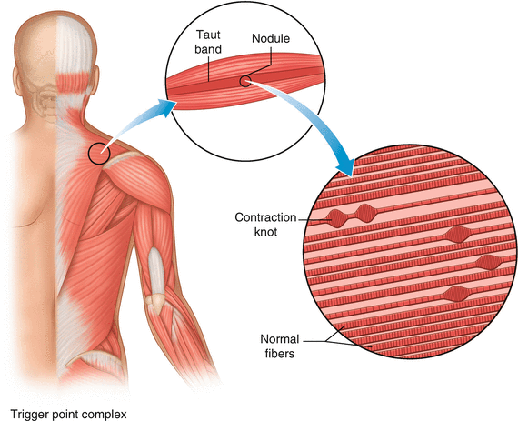 Myofascial Pain Syndrome | SpringerLink