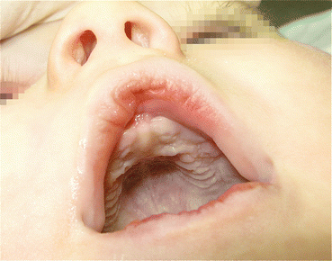 Autopsy And Histological Findings Springerlink