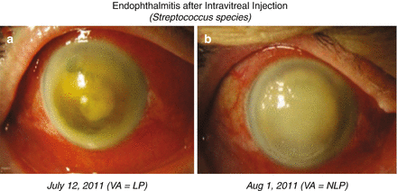 Endophthalmitis: Classification and Most Frequently Reported Organisms ...