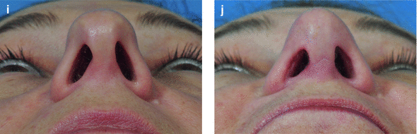 Nasal Base | SpringerLink