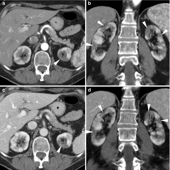 CT Imaging and Differential Diagnosis of Acute Pyelonephritis