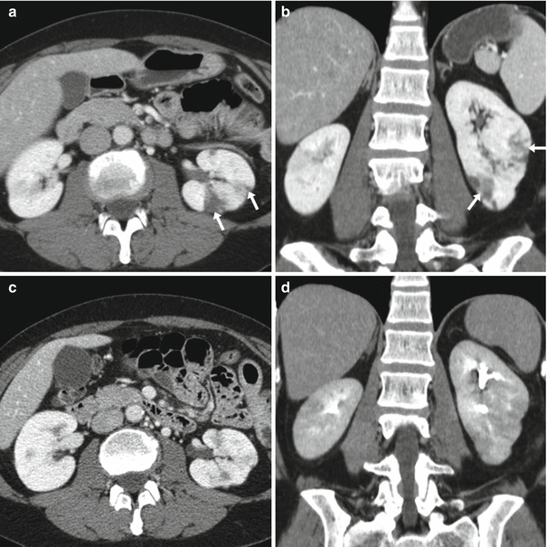 CT Imaging and Differential Diagnosis of Acute Pyelonephritis