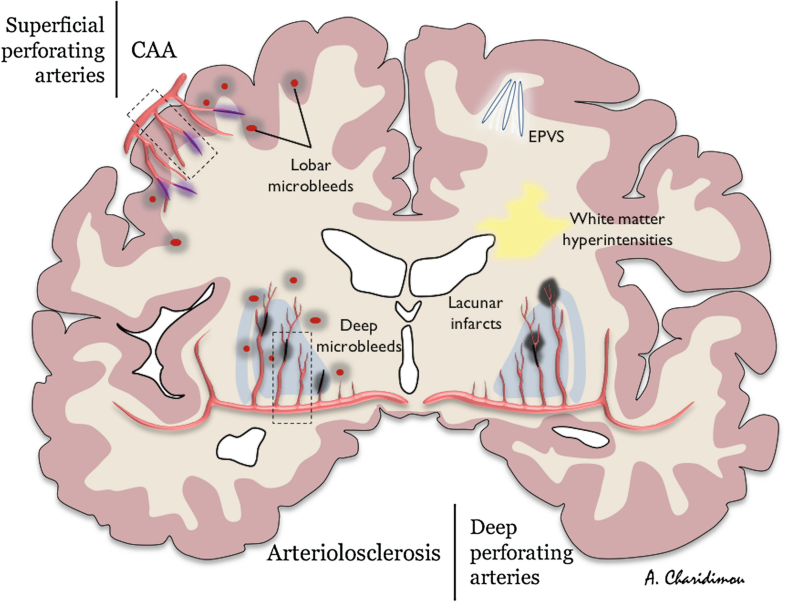 Small Vessel Disease | SpringerLink