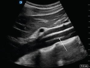 Aorta Ultrasound Measurements