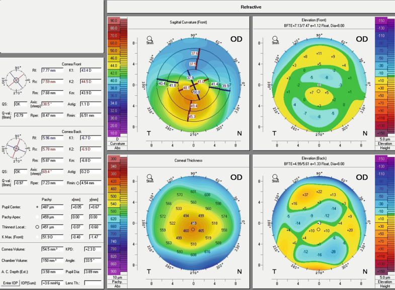 Introduction To Astigmatism And Corneal Irregularities Springerlink