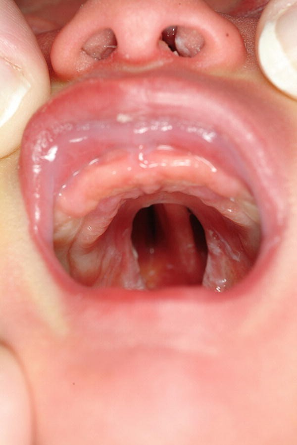 tonsillitis hipertónia magas vérnyomás keményedése