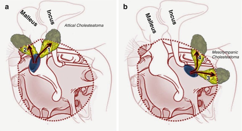 15 Chronic Suppurative Otitis Media Attico Antral Disease