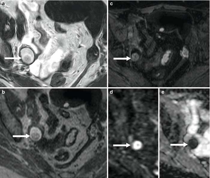 Adnexal Diseases Springerlink